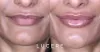 Botox and Fillers: Is There a Difference Between Them? - IAU