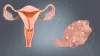 PCOS Specialist in Aurangabad | Hormone Specialist doctor in Aurangabad- Dr. Nilesh Lomte 
