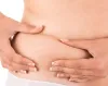 Stretch Marks Removal Treatment | Obesity &amp; Skin Care- Metamorphosis Clinic