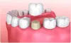 Why do you need the dental bridge?