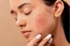 Acne Diet Plan Get Rid of Acne by Eating Healthier - Latest Natural Health News