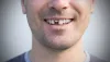 What Should You Do When You Break A Tooth?