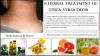 Natural Remedies for Tinea Versicolor with Helpful Home Ingredients - Dubai Entertainment