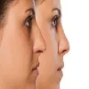 All About Alarplasty: Procedure, Cost, and Recovery