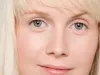  Dark Circles Removal Treatment Best Options  - Laser Skin Care Treatments in Dubai 