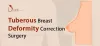 What are Tubular Breasts? - Causes &amp; Symptoms