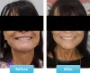 Dental Veneers Cost in Mumbai, Laminate and Veneers Dental Treatment