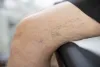 Online Notepad - What Are The Advantages of Taking Varicose Vein Treatment?