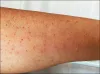 Side effects of Azoran - Alternatives in Ayurveda To Replace it