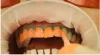 Professional Teeth Whitening & Bleaching