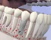 Replacing Missing Tooth Seattle - Dental Bridges / Dentures Treatment | PSOMS