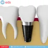 Affordable Dental Implant Arizona, Implants For Dentures Cost Arizona, Dental dentures Arizona, Dentures Teeth Arizona, Overdenture Implants Arizona,
