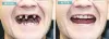 Prestige Dental | Dental Implant