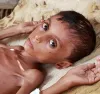 malnourished child symptoms