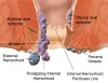 Best Treatment for Piles in Delhi | Piles Laser treatment 