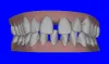 Invisalign Price In Harriman | Orange County Orthodontics