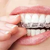 Invisalign® Dentist Alpharetta, GA | Healthy Smiles of Georgia