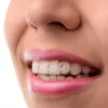 Invisalign Adelaide