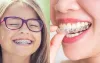 Invisalign vs. Braces: Pros, Cons, Faster Results?