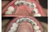 Invisible Lingual Braces in Dubai &amp; Abu Dhabi | Lingual Braces Cost