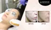IPL treatment New Jersey, IPL laser treatment New Jersey