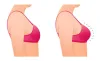 Is Breast Augmentation Safe?