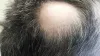 Is Hair Transplant as beneficial as it is talked about? – Vitamins Dot