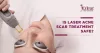 Is Laser Acne Scar Treatment Safe? - Skin Solutionz