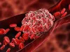 Deep Vein Thrombosis DVT - Blood Clots Denver - Westminster - AHVC