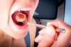 Does Your Gum Bleeds? Consult Periodontist Today