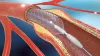 Coronary Balloon Angioplasty and Stenting in Colorado Denver - AHVC