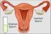 IUI Cost in Hyderabad