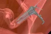 IVF Embryo Transfer Procedure - Everything You Need to Know in 2021