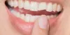 Chipped Tooth: Causes, Treatment, Recovery