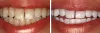 Is Laser Teeth Whitening a Better And Faster Option?