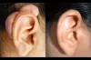 Scars &amp; Keloid Treatment in Dubai, Abu Dhabi &amp; Sharjah | Cost &amp; Deals