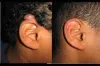 Scars &amp; Keloid Treatment in Dubai, Abu Dhabi &amp; Sharjah | Cost &amp; Deals