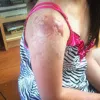 Keloids Treatment, Herbal Treatment for Keloids, Removal of Keloid Scars | Padanjali Ayurvedics