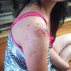 Keloids Treatment, Herbal Treatment for Keloids, Removal of Keloid Scars | Padanjali Ayurvedics