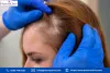 keratin_overproduction.jpg