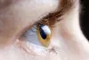 Keratoconus Treatment | Keratoconus Surgery Cost