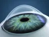 Keratoconus Treatment in india, Keratoconus Surgery In Mumbai