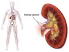 How to prevent Kidney stones with Ayurveda - Blog - Herbal &amp; Home Remedies