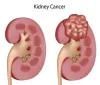 What Can You Expect From Kidney Cancer Treatment in Ayurveda?