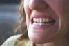 What Are The Effects Of Crossbite And How Can It Be Fixed?