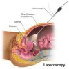 Laparoscopy Surgery in Mumbai, Navi Mumbai | Dr Ankita's Fertility Center