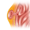Expert Laparoscopic Hernia Surgery in Dubai
