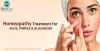6 Best Homeopathic Medicines for Acne, Pimples, Blackhead Treatment.
