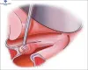 Best Laryngeal Surgery In Delhi