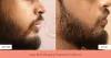 Best Full Body Laser Hair Removal Treatment Cost in Delhi, West Delhi, Rajouri Garden, South Delhi, India 